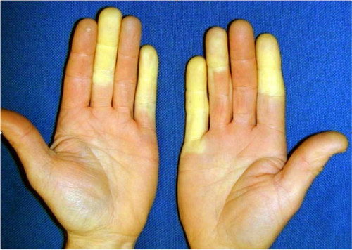 White Finger Syndrome caused by vibration